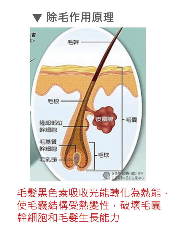 脈衝光除毛皮膚美容醫學 實際案例新竹安慎醫美皮膚科診所 電波音波拉提 玻尿酸