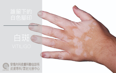 VITILIGO