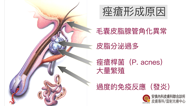 痤瘡形成原因